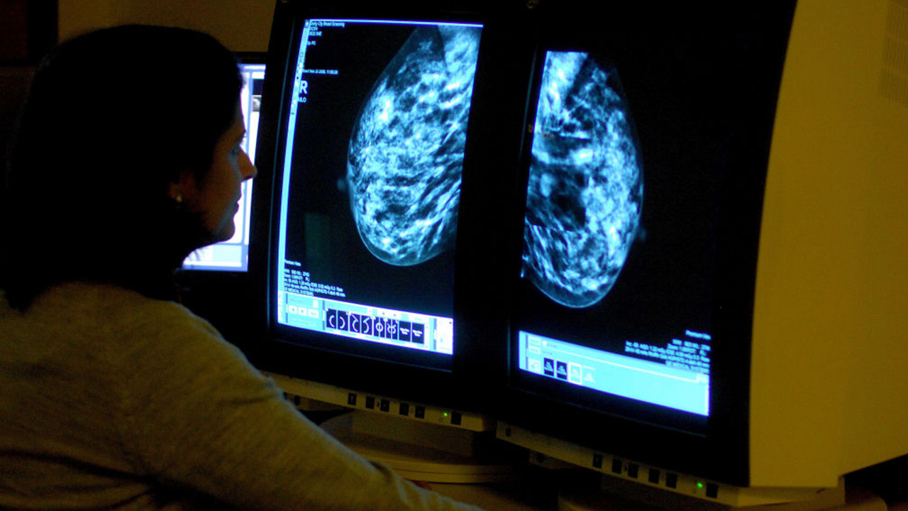Targeted drug shrinks tumors in 3 out of 4 patients with advanced breast cancer — Dunedin Schools news